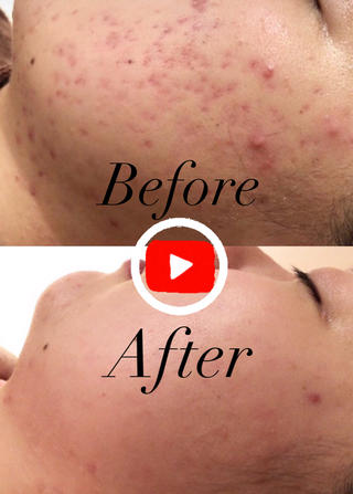 顔全体にできる赤ニキビ！！
治ってはまた出来ての繰り返し

そんな頑固ニキビが半年でぴかぴかに

皮膚科に通ってるのになんでだろう？
スキンケア頑張っているのに、、、

なかなかニキビが良くならない
その仕組みをAccueilでは
1人1人にお伝えしています

あなたのニキビの原因は何か知りたくないですか？

ニキビ0肌は誰でも手に入ります
気になった方は是非一度いらしてください♪

お待ちしております 