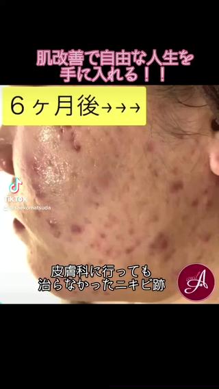 しつこいニキビ跡に 