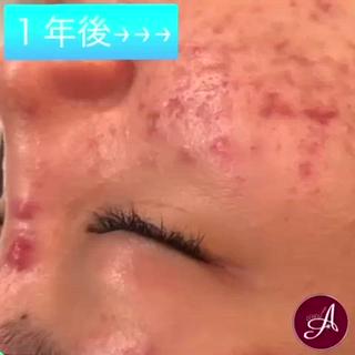 繰り返すニキビにニキビケア 