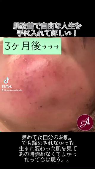ニキビ跡改善専門🔥 医療にはできない改善のエステ・リラクイメージ