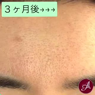 ニキビ跡、毛穴もキレイに！ 