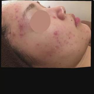 ニキビ跡改善専門🔥 医療にはできない改善のエステ・リラクイメージ