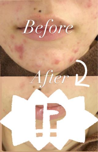 ずっと繰り返しがちな顎ニキビ
治ったと思ったのにまたできる

Accueilではそんな繰り返しニキビ卒業できます

動画のお客様は12回を半年間で通って頂きました！
卒業してからも、ニキビができない状態が続いているそうです

気になった方は是非ご予約ください
もちろんメンズのお客様も大歓迎です 