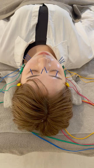 美容鍼の施術風景です。初めての美容鍼、刺激は心地良いとおっしゃられていました。 