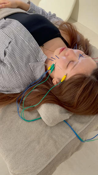 美容鍼の施術風景です。初めての美容鍼でしたが、電気もリラックスして受けていただけます。 