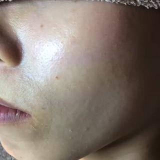 乳酸ピーリング1回のBeforeAfter

乾燥、ニキビ、肌のゴワつき気になる方にオススメです 