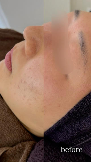 トリートメント3ヶ月継続して通ってくださった方のビフォーアフターです。
サロントリートメントだけでもしっかり変化でますのでお任せください。
#ニキビ肌#揺らぎ肌#乾燥#赤み#バリア機能強化#お肌の土台作り#クリスティーナ#アンストレス#ビオフィート
