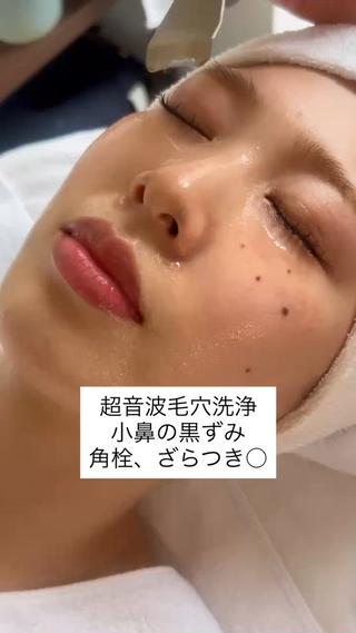 クレンジングの後に当店オリジナル
超音波毛穴洗浄で鼻の黒ずみの元になる
角栓、酸化した皮脂をしっかりとりのぞきます

1回でツルツルなるお鼻に♪
before afterもぜひ見てください

#毛穴洗浄#黒ずみ#小鼻#エステ 