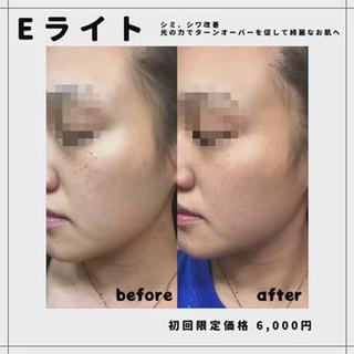 Eライトの施術効果のお写真です。
Eライトはしみ、シワの改善に有効な施術です。
是非一度お試しください(*˘˘*) 