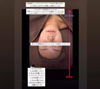 オプションで小顔エイジング 