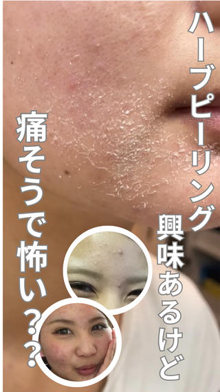 ハーブピーリングしたいけど痛そうだし、ちょっと怖いし、どうしよう？と悩まれている方に見て頂きたくて動画撮ってみました

当店のハーブピーリングは
全く痛くない物〜痛さレベル5段階があります

肌質によってもレベルを変える事で適切な施術を
させて頂いております

気になる事があればメッセージで質問して下さいね
 