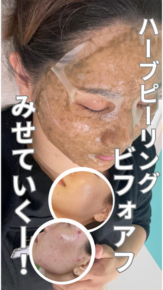 ハーブピーリングのビフォーアフターです
是非ご覧ください 