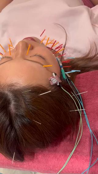 【美容鍼灸効果】
•小顔効果
•美肌
•むくみの改善
•目の下のくま
•くすみ
•目の疲れ
•シワ、シミの軽減
•リフトアップ
•ほうれい線
•不眠
•自律神経
•たるみ改善
•乾燥肌の改善（水分保持量アップ）
•お顔の左右差の改善
•ターンオーバー促進
•睡眠の質改善
•便通改善
•生理不順改善
【このようなお悩みございませんか】
お顔の形が変わってきた
首肩こりがつらい
お顔のたるみやむくみ
お肌トラブルがあり安定しない
くすみや目の下のクマが気になる
頭痛が多く薬が手放せない
眼精疲労で疲れが取れない
不眠が続く、寝つきが悪い
美容鍼灸で心身ともに改善、より美しくなりましょう

 