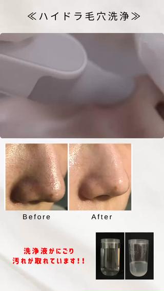 【ハイドラ毛穴洗浄】 水を一切使わず、40種類以上の美容液で毛穴を洗うという新発想の美容技術です。 ピーリング効果のある美容液は毛穴の汚れや古い角質を柔らかくし、肌を痛めることなく汚れを取り除きターンオーバーを促進させます。 渦巻き状のノズルで汚れを吸引しながら特殊な水流で毛穴を洗浄するため、汚れや角質を取り除くのと同時に肌へ有効成分と潤いを与えます。  乾燥肌やオイリー肌・ニキビ肌など、肌質を問わず、角質除去、毛穴の浄化・引き締め、細かなシワやくすみを改善するなど、幅広い効果が得られます。 ピーリングに起こりやすい肌荒れもありませんのでダウンタイムもなく、施術後すぐにメイク可能です。

 