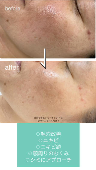 グリーンピール（GP)は元祖ハーブトリートメントです。
皮膚科医によって開発されたトリートメントで、沢山の方が美しく健康的な肌を手に入れてます。ですので国際認定されたエステティシャンや医師のみが提供できる技術です

GPはピーリングではありません。天然植物１００％のハーブで、角質のメカニズムに着目したトリートメント。ケミカルピーリングと違い肌が求める自然の成分のみを使用するため、いろいろな肌トラブルにも対応できます。
世界で一つのハーブトリートメント、肌のターンオーバーを正常化し若々しい本来のお肌を手に入れてください。

エステラボｅｉ-B

#ニキビ改善サロン 
#医療提携サロン 
#フェイシャル
#メンズフェイシャルサロン 
#メンズフェイシャルエステ 
#ニキビ 
#メンズニキビケア 
#メンズフェイシャルモニター
#スキンケア 
#ニキビ跡 
#メンズニキビ跡 
#肌質改善 
#肌質改善奈良 
#50代フェイシャル 
#40代フェイシャル 
#40代フェイシャルエステ 
#男身だしなみエステ 
#スキンケアエステ 
#メンズスキンケア 
#メンズダイエット 
#ボディーメンテナンス 
#メンズダイエット 
#メンズダイエットサロン 
#エステ王寺 
#メンズダイエットサロン王寺
#ダイエット奈良 
#ダイエットチャレンジ 
#メンズダイエットチャレンジ 
#奈良体質改善 
#斑鳩エステサロン 
#グリーンピール 
#結果の出るサロン  