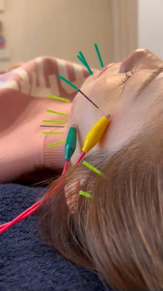 何回か受けていただいてる患者さん
肌質が変わってきたみたいです 