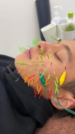 インフルエンサーのくさでぃーに百美鍼をしました 