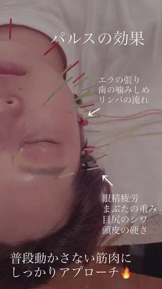 美容鍼
パルス（電気）の効果
普段動かすことの少ない筋肉の
2ヶ所にアプローチ

エラの張り解消
歯のくいしばり解消
リンパの流れをよくする

眼精疲労解消
まぶたの重みを改善
目尻のシワをリフトアップ
頭皮の硬さを軽減

ミニモ30本お試しメニューでは
気になるどちらか1ヶ所の施術となります 