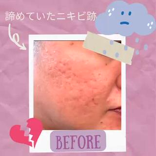 ニキビやニキビ跡にすごくいいです
回数重ねるとシミや薄いシワ、毛穴も消えていきます
植物由来ではなく珊瑚などの海綿体でできてるのでアレルギーの心配もなく、どんな肌にも対応できるのがハーブリプロです
どんな化粧品でも合うような強い肌作りができるピーリングはハーブリプロだけ！
生理の時の肌荒れをなくして、揺らぎのない肌を目指しましょう 