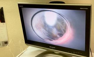 耳そうじの様子を少しだけ公開!耳垢の映像が表示されます