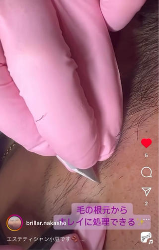 メンズ美容電気脱毛の施術中を大公開 