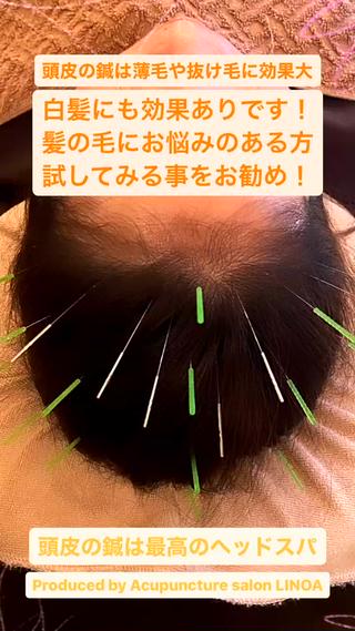 白髪、薄毛、ボリューム不足など髪の毛のお悩みはこちらのコースがオススメ！ 