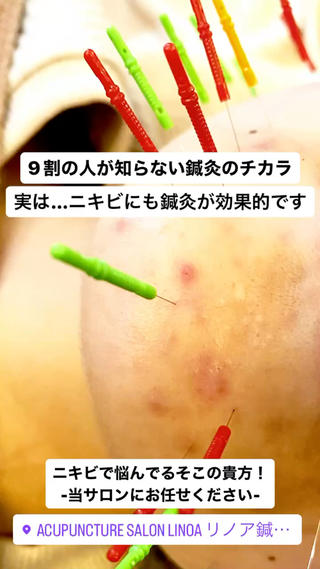 ニキビにも鍼が有効です！ニキビを治して自慢のツヤ肌になりましょう！ 