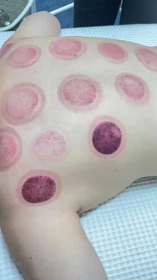 「最近、なんとなく身体が重い…」「肩こりや背中の張りが取れない」
そんな方におすすめなのが、伝統療法「カッピング」。

カップを使って皮膚を優しく吸引し、
︎ 血流促進
︎ 筋肉のコリを緩和
︎ 老廃物の排出をサポート

まるで身体の“内側”から掃除してくれるような感覚。
施術後は「背中が軽い！」「ぐっすり眠れた」との声も多数

#アロマオイルで心も体もリラックス #むくみ解消と小顔ケアの専門サロン #癒しと美を届けるプライベート空間 #疲れた身体にご褒美アロマトリート #リンパを流してスッキリボディに 