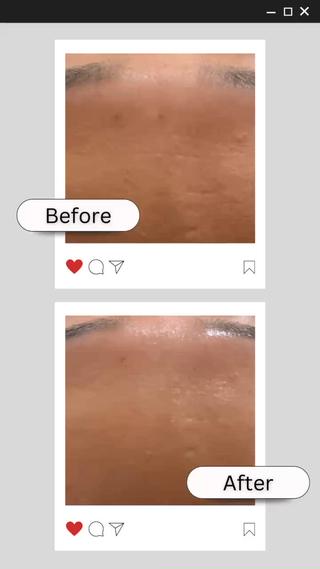 ハーブピーリングでは1回でも効果を感じられる方が多いです 