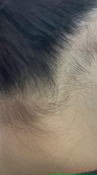 うなじのシュガーリング脱毛

うなじ美人 