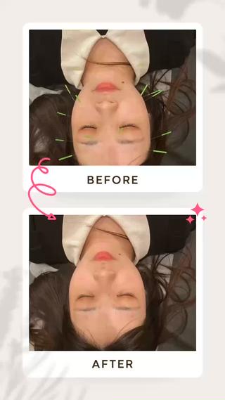 鍼後の血流アップの状態。筋肉のはり、肌のハリも改善され、深いところからリフトアップ。循環が良くなり、ターンオーバーも良くなります！ 