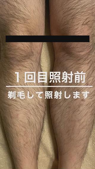 最新型NPL方式脱毛マシンで
主にバルジ領域をターゲットとしているため、
照射後から成長が緩やかになり剃毛が楽になったと、
脱毛期間中も気持ちよく通うことができます
産毛・白髪・金髪・日焼け肌にもOK
美肌効果も兼ね備えた脱毛をお試しください 