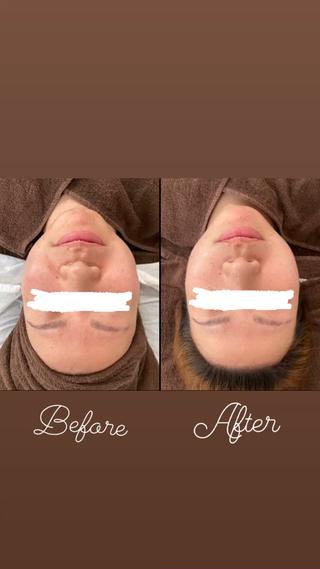 1度で変わる！
肌の透明感
フェイスライン
化粧ノリup
1度でこんなに変わるから、
続けたらその分効果は持続

おおよそ月1で通われているお客様が多いです
ペースは人それぞれなので、
「自分はどうやったら続けられるか」
お肌の状態と合わせて一緒に考えましょう
もちろん！相談のみは無料です！
いつでも連絡ください 