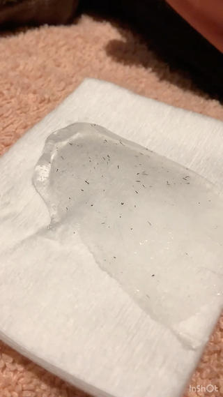 メンズ脱毛/髭光脱毛 