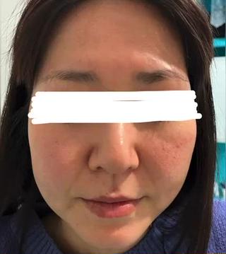 ハーブピーリングモニター様3回施術。
くすみが取れて、トーンアップし、キメが整い赤みも薄くなりました。
生理前後の施術で施術後、ニキビの治りが早くなったとご報告いただきました。
お肌のお悩みがある方ぜひせんげん台駅Relair.Lakaまでご相談ください 