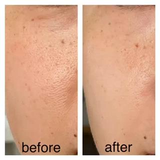 フェイシャルエステ1回でのbefore、afterのお写真です♪ 