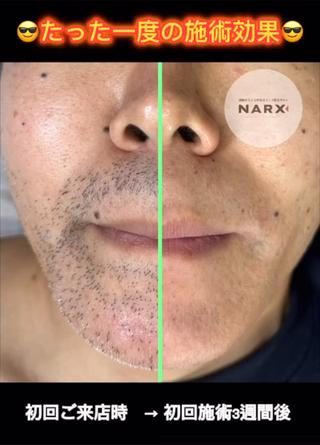 ＼たった1ヶ月でヒゲ剃り不要／

中島式脱毛ではたった一回でもこの効果
毎朝のヒゲ剃りに悩んでいた沢山のお客様に感動して頂けています

貴方も毎朝の面倒なヒゲ剃りから解放されませんか？ 