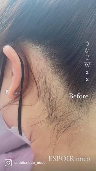 うなじWax脱毛+光脱毛
W脱毛で美しいうなじになります♡