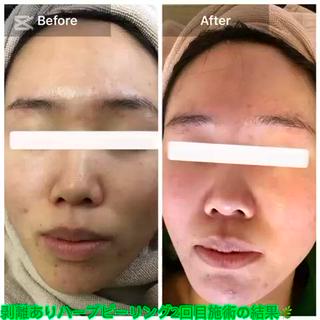 ハーブピーリング一回でも効果を感じられるとのお声が多数寄せられてますニキビニキビ跡などのお悩みのお客様は是非一度ご来店ください 