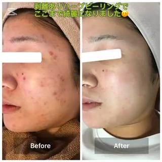 ハーブピーリング 専門店MOKA所属・ハーブピーリング専門 MOKAのエステ・リラクイメージ