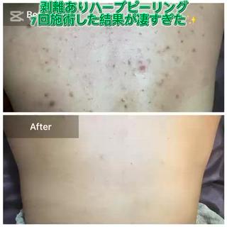 ハーブピーリング 専門店MOKA所属・ハーブピーリング専門 MOKAのエステ・リラクイメージ