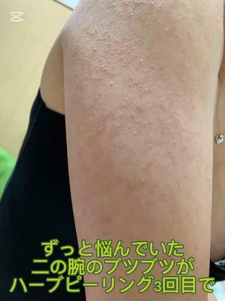 このお客様は剥離ありハーブピーリング3回ほどで気にならなくなったと、喜ばれてましたいつも二の腕がでないファッションしていたそうで、これからはノースリーブも挑戦したいとのことでした 