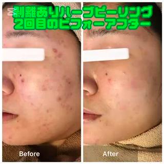 剥離有りハーブピーリング2回目施術の結果！
目に見えてニキビ跡やニキビが減ってきてます☆
お客様も大変満足されてます 