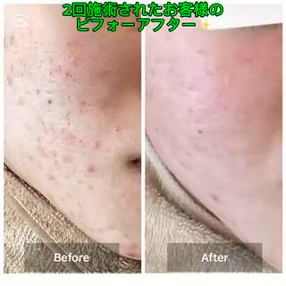 ハーブピーリング 専門店MOKA所属・ハーブピーリング専門 MOKAのエステ・リラクイメージ