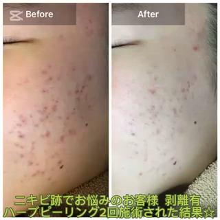 ハーブピーリング 専門店MOKA所属・ハーブピーリング専門 MOKAのエステ・リラクイメージ