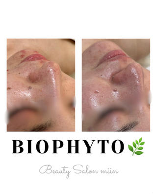 品質の高さで知られる𝐂𝐇𝐑𝐈𝐒𝐓𝐈𝐍𝐀
𝐵𝐼𝑂𝑃𝐻𝑌𝑇𝑂（ハーブピーリング）です(^^)

˗ˏˋ こんなお肌悩みの方へ ˎˊ˗ 

・赤みが出やすい方
・食生活やストレスで肌荒れする方
・角質がごわごわする方
・たるみ毛穴、黒ずみでお悩みの方
・引き締め、弾力、透明感が欲しい方
・ニキビ、ニキビ跡でお悩みの方

˗ˏˋ 期待できる効果 ˎˊ˗ 

ハーブを使ったハーブピーリングで
血流を良くし、肌の新陳代謝を良くします♪
お顔のむくみ、ニキビ、ニキビ跡、しわ、肌荒れ
クマなどのお悩みに効果が期待できます！

〖 ダウンタイム、剥離はございません 〗
 