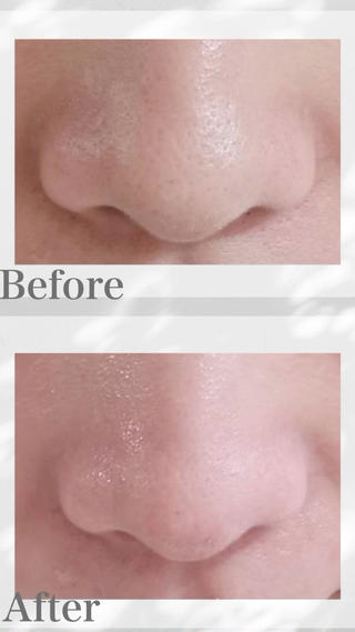 30代/女性　　
Before after写真です
⁡
通常¥16,500              ︎︎︎           初回¥8,500
２・３回目も４０%off
４回目以降も２０%off（※条件あり）
⁡
アクアピール/ハイドラフェイシャルで肌に負担をかけずに
毛穴の黒ずみ・角質汚れを除去！
お悩みに合った美容液導入＆浸透
コラーゲン生成促進＆リフトアップ！
⁡ 