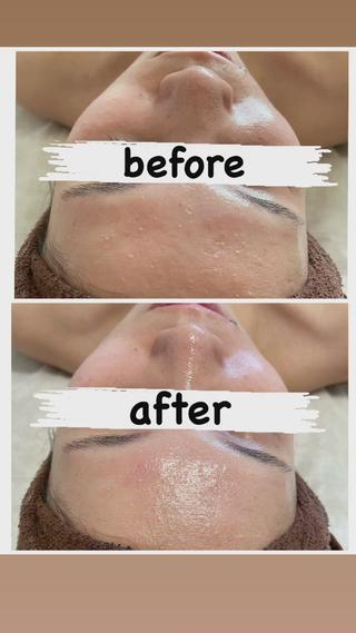 初めての陶肌トリートメント
ミニモからご予約頂きました♡

一度の施術で、この変化

女性ならではのお悩みってみんな持っていると思います。
当店にご来店頂くお客様の98%が、シミ・シワ・くすみ・毛穴・繰り返すニキビなど肌トラブルのご相談をお受けします
どれかお一つでも当てはまる方は、是非一度陶肌トリートメントを受けてみてください

しっかり、カウンセリングを行いますので何でもご相談ください 