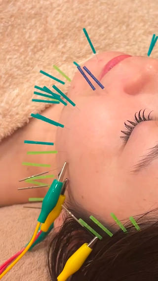 ほうれい線に特化してたるみ撃退

1回でもここまで変わりました

紫外線によりお肌のコラーゲンが壊されると
たるみやシワの原因となります…

そうなる前に美容鍼でコラーゲンを生成
→ハリや弾力upさせましょう！！ 