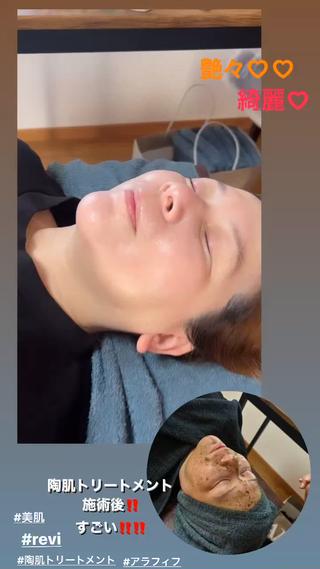 ハーブピーリング/韓国肌管理/フェイシャル/毛穴洗浄/眉毛/顔脱毛【糸脱毛専門】rev所属・ハーブピーリング🌹 毛穴洗浄❤️眉waxのエステ・リラクイメージ
